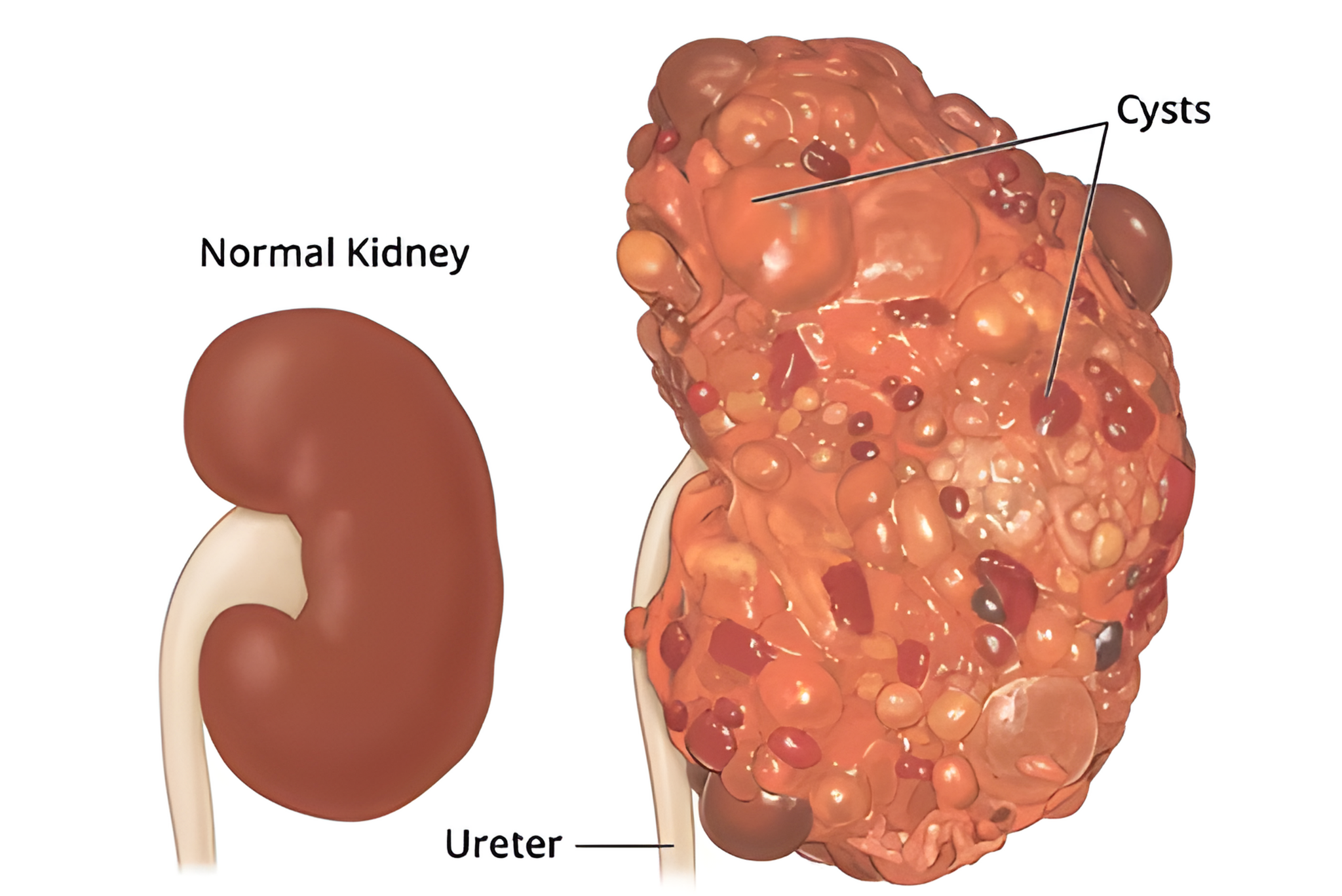 Polycystic Kidney Example